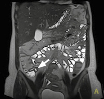 Coronal T2-weighted image shows subtle terminal ileal thickening