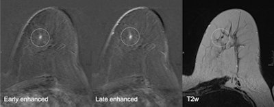 A 52-year-old patient who had breast cancer five years previously. MRI detected focus in the left craniomedial breast called BI-RADS 4, and a second opinion was requested. All images courtesy of Dr. Pascal Baltzer.