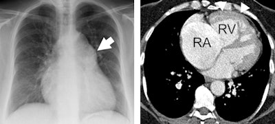 Left: Patient with pulmonary hypertension. Conventional chest x-ray (A) shows enlarged pulmonary artery (white arrow); pulmonary circulation is compensated. Right: Contrast-enhanced CT yields enlarged right atrium (RA) and ventricle (RV). Hypertrophy of RV myocardium (arrowheads) indicate chronic RV pressure overload. Images courtesy of Dr. Jens Bremerich.