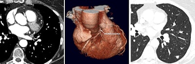 Patient presenting with suspected anomalous right coronary artery. Coronary CT angiography shows interarterial right coronary artery (left, also shown on 3D reconstruction in center). Full field-of-view reconstruction reveals spiculated lung lesion, which proved to be metastatic breast cancer (right). Images courtesy of Dr. Edwin van Beek, PhD.