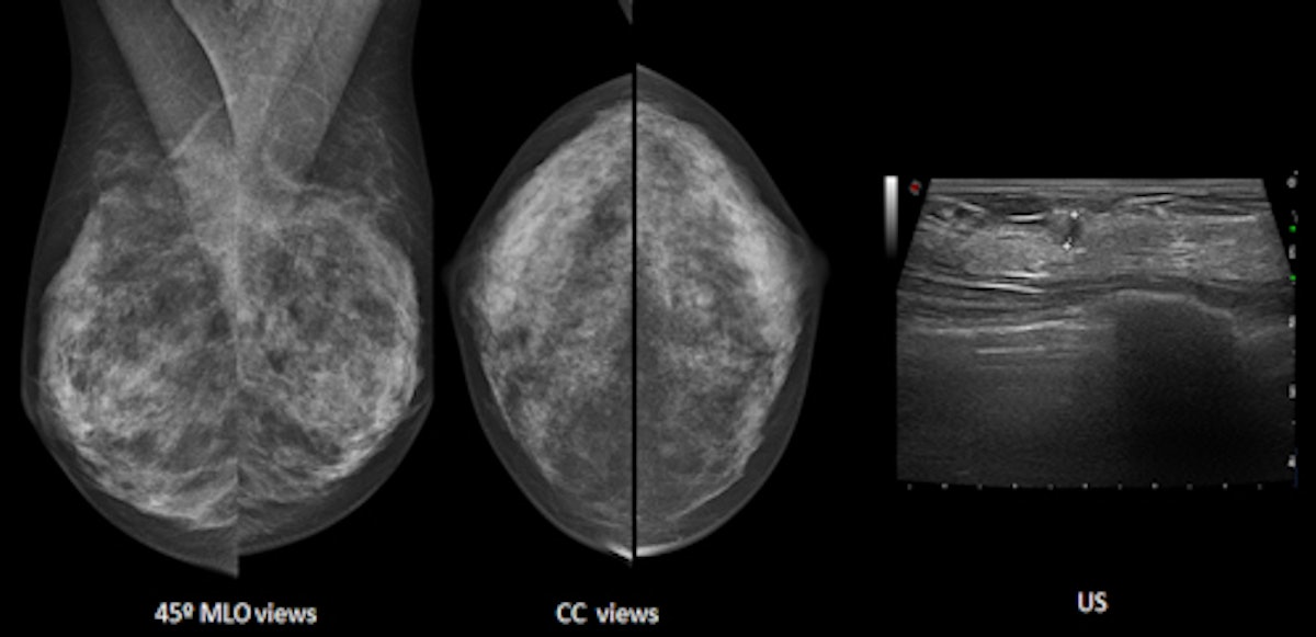 Basics of Breast Ultrasound - Radiology