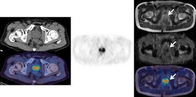 Left: F-18 choline PET/CT (CT top and fused PET/CT bottom). Center: F-18 choline PET. Right: MRI (from top to bottom: T2, ADC map, fused PET/T2 MRI). The images clearly show abnormal choline activity in a large prostate cancer. However, the CT image does not allow any anatomical definition of the local extent of the tumor. The higher tissue contrast on the T2 MRI allows better definition (arrow) of the organ confined cancer, correlating with choline uptake on the fused PET/T2 MRI scan, and confirms restricted diffusion on the ADC map.
