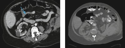 Left: Free air collection (arrow) close to the duodenum, misdiagnosed as normal intraluminal air. Right: One day later, the patient shocked, and a CT performed by means of oral contrast agent and by using bone window setting showed considerable amount of free abdominal air. Images courtesy of Dr. Raffaella Basilico.