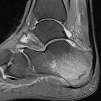 2016 03 04 17 29 21 744 Mri Stress Fracture 200