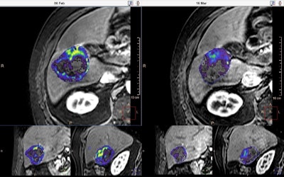 Oncologic image displayed on Philips IntelliSpace Portal 8.0 showing quantitative tumor viability (qEASL*) before and after transarterial chemoembolization (TACE). Much of the viable tumor (colored) becomes less enhanced (transparent) after the treatment.
