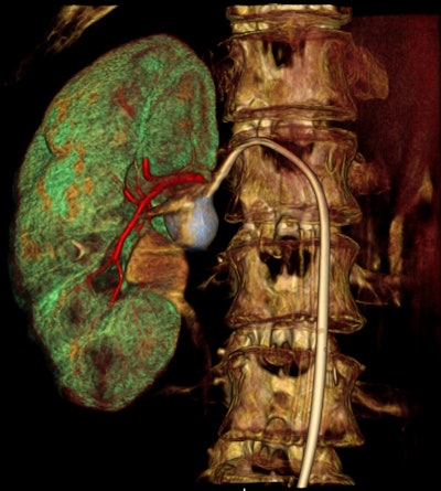 Image of a renal aneurysm acquired with Toshiba's Infinix-i Rite Edition digital radiography system.
