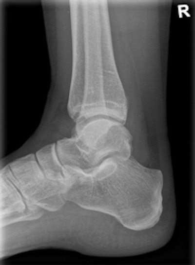 Clinical image of an x-ray examination of the ankle joint. Copyright: Radiology Department, University Hospital Erlangen, Germany. Image courtesy of Siemens.