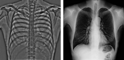 Dual-energy subtraction images of bone and soft tissue. Images courtesy of Shimadzu.
