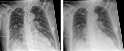 Chest radiographs taken with SkyFlow scatter suppression algorithm and standard acquisition. Image courtesy of Philips