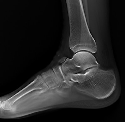 Tomosynthesis image of an ankle taken with Shimadzu's RADspeed Pro digital radiography system.