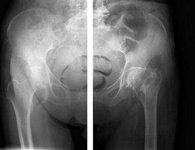 Pelvic radiographs taken with and without SkyFlow scatter suppression algorithm. Image courtesy of Philips.