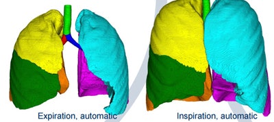 Final automated segmentation result with lobe masks generated by distance measured to labeled bronchi and vessels, with expiration at left and inspiration at right. Image courtesy of Oliver Weinheimer, PhD.
