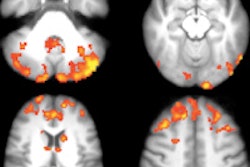 2016 03 08 18 11 47 151 Degiglio Ms Mri Fig1 200