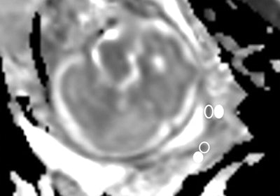 The ADC map gives a value of 2,681 x 10-6 mm2/sec in the subglandular area (empty oval). The patient gave birth four days later. Images courtesy of Radiology.