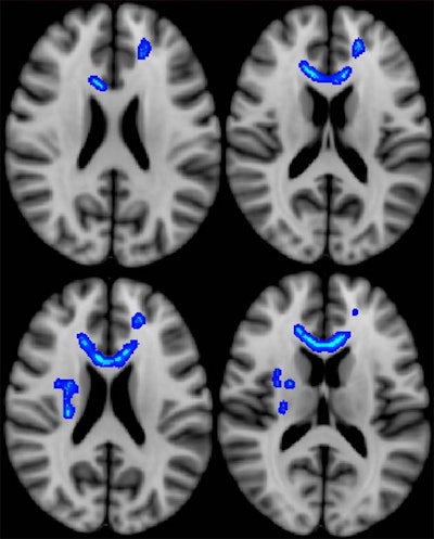 Diffusion-tensor MR images show regions of the brain (blue) in which lower fractional anisotropy correlates with more severe neurobehavioral symptoms. Veterans with the most severe symptoms had lower microstructural integrity in these regions. Image courtesy of Radiology.