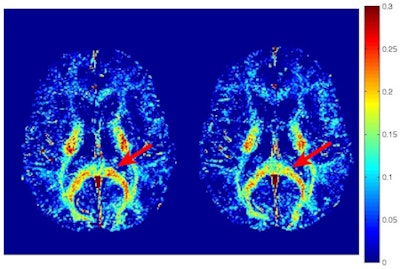 Myelin water fraction maps show a concussed athlete at baseline (left) and two weeks after the injury (right). A region of the corpus callosum had a visible reduction in myelin water fraction postinjury (red arrow). Image courtesy of PLOS One.