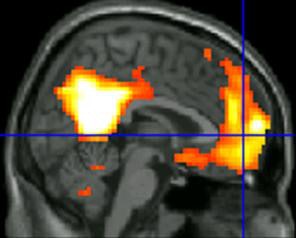 Functional MRI highlights two brain regions where veterans trained in mindfulness saw the greatest increases in connections. Image courtesy of the University of Michigan/VA Ann Arbor.