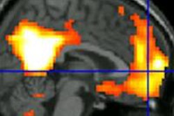 2016 04 01 16 00 11 460 Ptsd F Mri Depand Anx 296 20160401230036