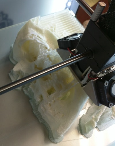 3D-printed educational model of complex maxillofacial and orbital trauma. Image courtesy of Dr. Edward Quigley, PhD.