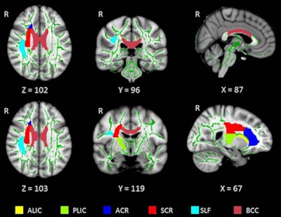 DTI shows the distribution of the six whole white-matter tracts in the brain. ALIC = anterior limb of the internal capsule, ACR = anterior corona radiata, BCC = body of the corpus callosum, PLIC = posterior limb of the internal capsule, R = right side of the brain, SCR = superior corona radiata, SLF = superior longitudinal fasciculus. Image courtesy of RSNA.
