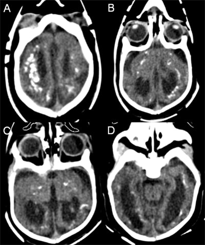 Axial head CT images of an infant with congenital microcephaly associated with intrauterine Zika virus infection show punctate and larger calcification with a band-like distribution periventricularly, and at the level of the corticomedullary junction within the frontal, parietal, and temporal lobes bilaterally. Ventriculomegaly and global cortical hypogyration are also noted. Image courtesy of Dr. Andrea Poretti.