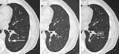 CT images of small cell carcinoma in the left lower lobe. At time point 0, when the lung cancer was small, it was missed by the interpreting radiologist (left, arrow), but it was detected by two of the four CAD systems (middle and right). Image republished with permission from RSNA, from Liang et al, Radiology, March 28, 2016.