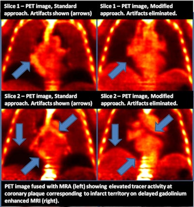 Images show how Mount Sinai's MR attenuation correction technique (right column) eliminates artifacts (arrows) compared with standard attenuation correction (left column, arrows). Images courtesy of Dr. Marc Dweck.