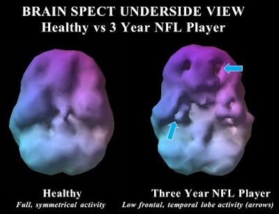 SPECT reveals asymmetry and hypoperfusion in the brain of a football player (right) compared with a healthy control (left). Image courtesy of UCLA Medical Center.