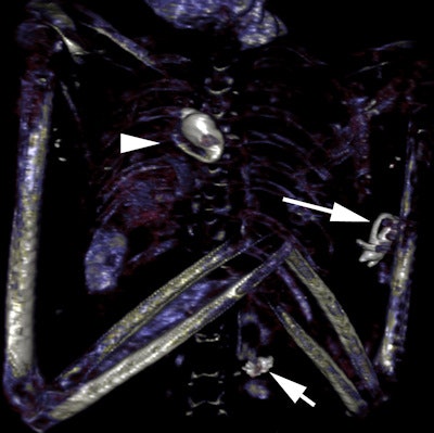This 3D CT image of the chest of Seti I shows three amulets: a heart amulet within his chest, an Eye of Horus within the wrappings posterior to his left humerus, and an Eye of Horus amulet within the wrappings of his lower back.