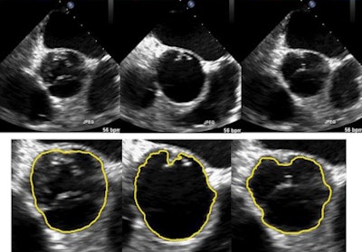 Selected frames of the original ultrasound images (left to right) and the region of interest (ROI) tracking results (top to bottom). Image credit: Xiaoqun Zhang.