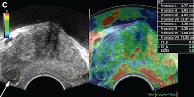 Elastogram from a 71-year-old man with prostate cancer in the peripheral zone that was classified as a highly suspicious focal lesion on transrectal sonography. Elastogram shows higher stiffness (blue) at the lesion (arrow). Each region of interest had an area of 0.31 cm2 and was located 0.2 mm from the outer margin of the prostate. The lesion had a strain index of 3.3 and the area was confirmed as prostate cancer with a Gleason score of 9. Image courtesy of the Journal of Ultrasound in Medicine.