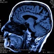 2015 11 12 10 29 21 842 Brain Mri 200