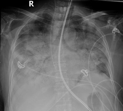 Above: Frontal chest radiograph performed when the patient was admitted with adult respiratory distress syndrome to the ICU. The x-ray shows bilateral extensive airspace disease with ground-glass opacities and consolidation (chest radiographic score 18). Below: Coronal section of a chest CT reveals early depiction of bilateral peripheral multiple ground-glass opacities in both lung fields.