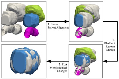 Overview of the registration techniques used in FEM. The post-treatment bladder, prostate, and rectum are shown in green, blue, and pink, respectively. Pretreatment surfaces are shown in gray. Quantitative measurements reflecting changes can be used to track treatment response over time. Image republished with permission of PLOS One, from Robert Toth, Dan Sperling, Anant Madabhushi: http://dx.doi.org/10.1371/journal.pone.0150016.