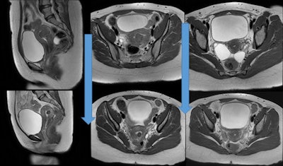MR images before and after UFE of 32-year-old patient with a 5-cm submucosal fibroid