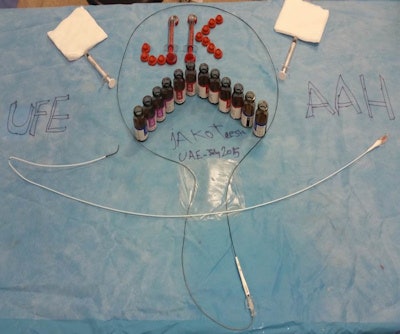 الأدوات التي تستخدم عادة في علاج الأورام الليفية الرحمية بالقثطرة: Robert catheter, microcatheter, and embolization particles.