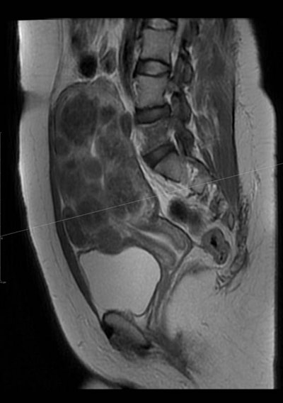 MR image of the uterus in a 29-year-old woman showing multiple uterine fibroids
