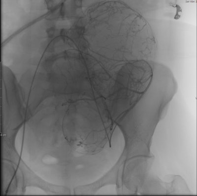 Left Uterine Fibroid Embolization In Progress