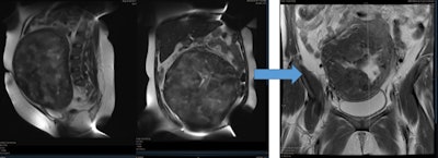 Single fibroid in 34-year-old woman with severe menorrhagia with anemia