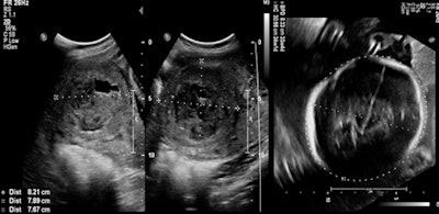Patient who became pregnant eight months post UFE