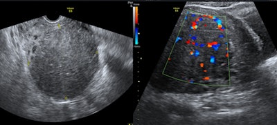 34-year-old woman with uterine fibroid treated by UFE
