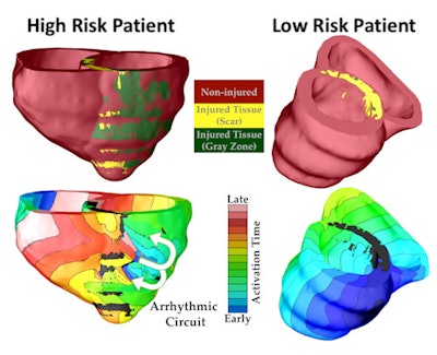 The virtual heart methodology classified one patient as high risk of developing a life-threatening arrhythmia, and the other as low risk. Top panels show the geometric replicas of the patient hearts, reconstructed from their MRI scans. Shown is normal tissue as well as injured tissue left by an earlier heart attack in each heart. The injured tissue consists of scar and a semiviable border zone between normal tissue and scar (also called gray zone because of its gray appearance in the MRI scan). Bottom panels show propagation of electrical wave in the virtual hearts, with lines representing times at which the electrical wave arrived at given locations in the heart (called activation times). In the low-risk heart, despite the presence of injury, the electrical wave swept uniformly through the heart, triggering strong uniform contraction and blood pumping. In the high-risk heart, arrhythmia developed. The electrical wave was 'stuck' at the scar, rotating around it over and over again, which is called arrhythmia (arrows show direction of rotation, i.e., the arrhythmia 'circuit'). The rotational wave was unable to cause coordinated contraction and prevented the heart form pumping blood effectively, which results in sudden cardiac death unless a defibrillation shock is given. Image courtesy of Hermenegild Arevalo and Natalia Trayanova.
