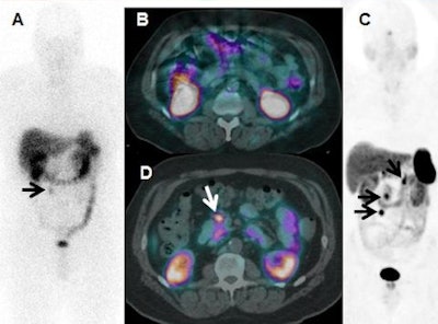 In-111-DTPA-octreotide scan (A) demonstrates recurrent mesenteric nodule (arrow) on the anterior view in a patient with a midgut carcinoid tumor resected five years previously, with no other tumor seen with planar imaging or SPECT/CT (B). Ga-68 DOTATATE PET/CT anterior 3D maximum intensity projection (C) and axial fused images (D) show other metastases (arrows), changing the surgical plan for resection. Findings were verified at surgery. Image courtesy of Dr. Ronald C. Walker.