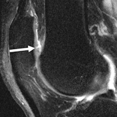 osteoarthritis knee mri