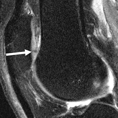 MR images of the right knee show signal abnormalities at baseline and subsequent defects at the 48-month follow-up. Above image shows a hyperintense signal abnormality in the patella at baseline (arrow). Image below shows the development of a fissure in the same patient (arrow) at 48 months. Images courtesy of Radiology.
