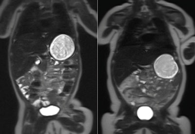 MRI scans of two babies at 10 weeks old. The child on the left was born to a healthy mother, while the child on the right was born to a mother with gestational diabetes. The white area on the outside of the body is fat tissue. Image credit: Imperial College London.