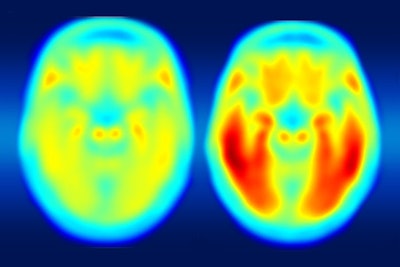 Red areas of PET images with T807 indicate greater accumulation of tau protein. The image on the left shows average tau accumulation in the brains of cognitively normal people, averaged over many individuals. The image on the right shows the average amount of tau buildup in the brains of multiple people with mild Alzheimer's symptoms. Images courtesy of Dr. Matthew Brier.