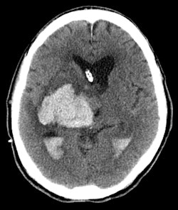 Patient with hemorrhage at head CT. Image courtesy of Dr. Gelareh Sadigh.