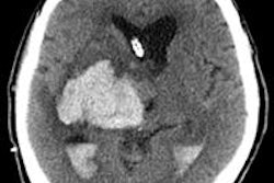 2016 05 13 09 25 03 381 2016 05 Sadigh Ct Head Hemorrhage 250 20160513162532