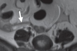 2016 05 18 14 45 01 363 Mri Appendix Radiology 200